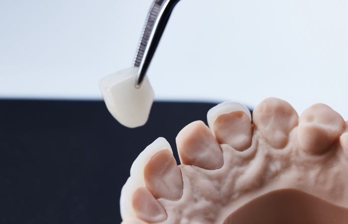 Porcelain Veneers - Parkwood Dental