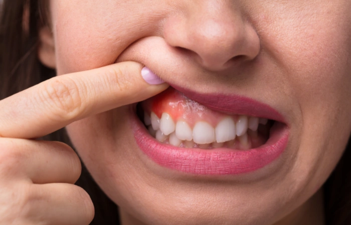 stages of periodental disease
