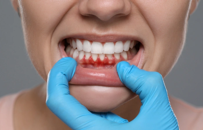 stages of periodental disease