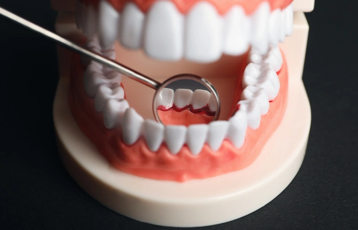 types of gum disease