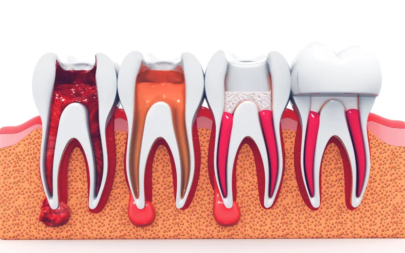 should root canal hurts