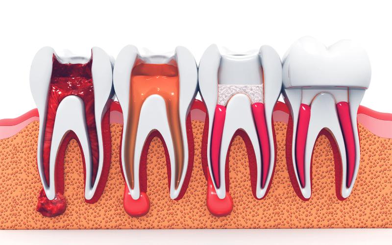 Why Postponing Root Canal Appointment Can Be Risky