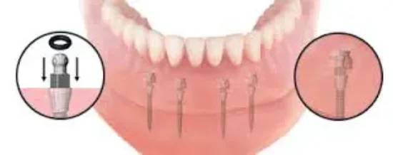 denture.img